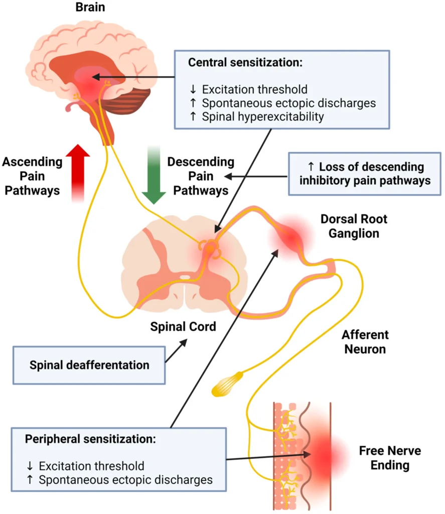 Post-Herpetic Neuralgia Infographic
